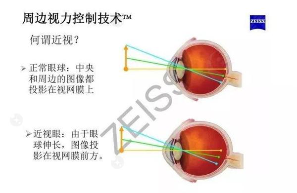 来看看亳州当兵视力矫正手术多少钱，亳州近视眼手术性价比高