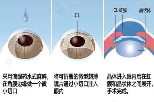 晶体植入手术