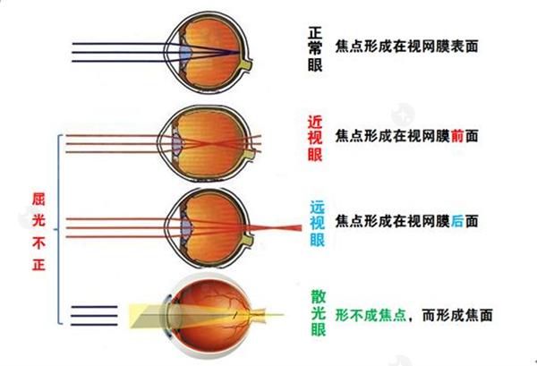 我近期感觉我的视力有些模糊，可能是近视加重了，该怎么办呢？