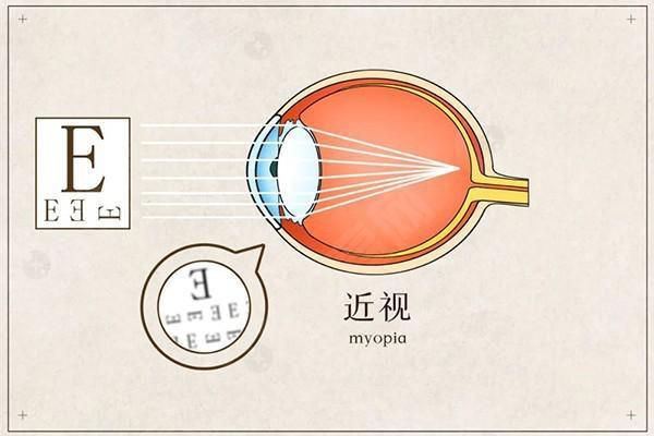 曝光福州TICL晶体植入近视眼手术收费贵吗，TICL晶体植入近视眼手术35000+