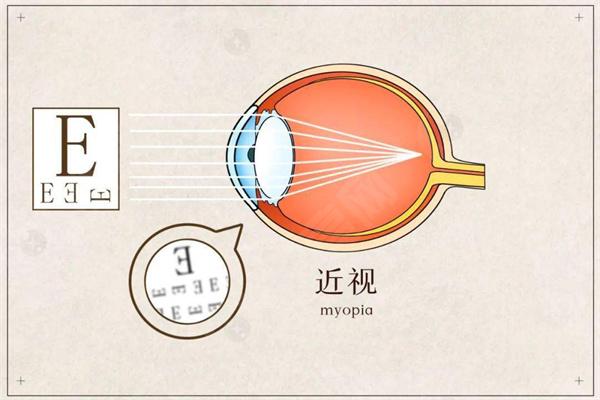 有什么方法可以帮助我改善近视眼的视力？